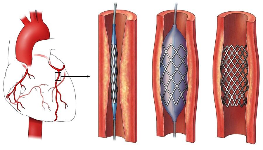 Cardiology_Cardiac_Interventions